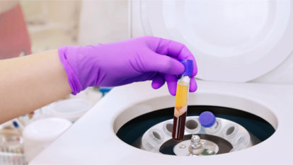 A gloved hand removing a vial of blood that has spun in a centrifuge to make platelet-rich plasma.